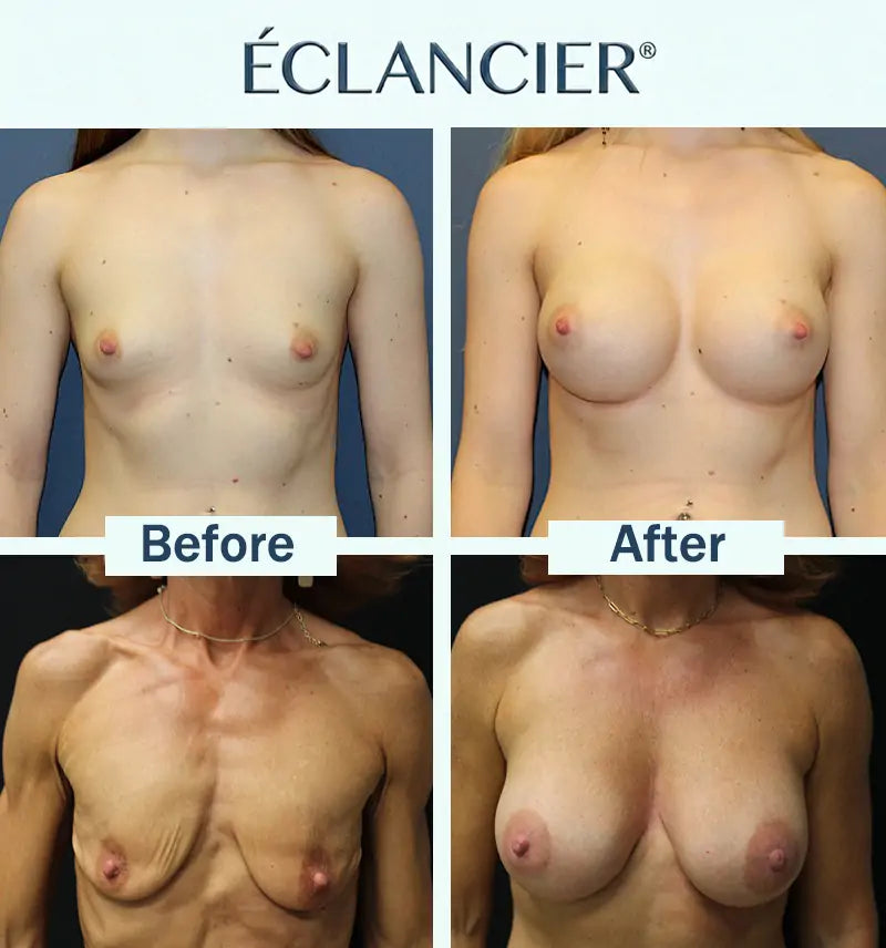 LUMIVO™ Targeted Breast Enhancement Advanced Nano Microneedle Patch