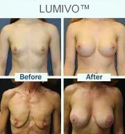 LUMIVO™ Targeted Breast Enhancement Advanced Nano Microneedle Patch
